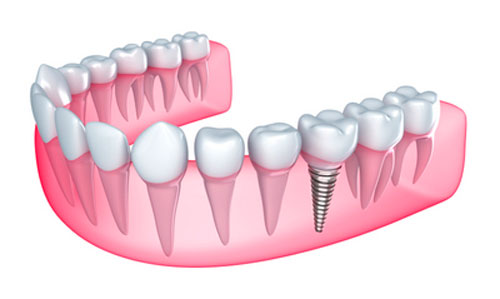Why Would My Dental Implants Failure?
