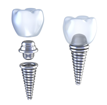 Diagram of the different parts of a dental implant at Portland Emergency Dentist