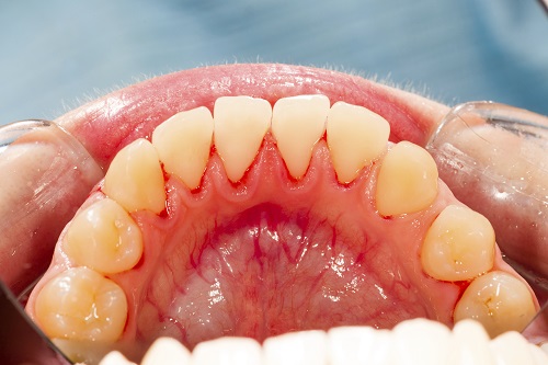 What to Do If You Notice Symptoms of Gum Disease