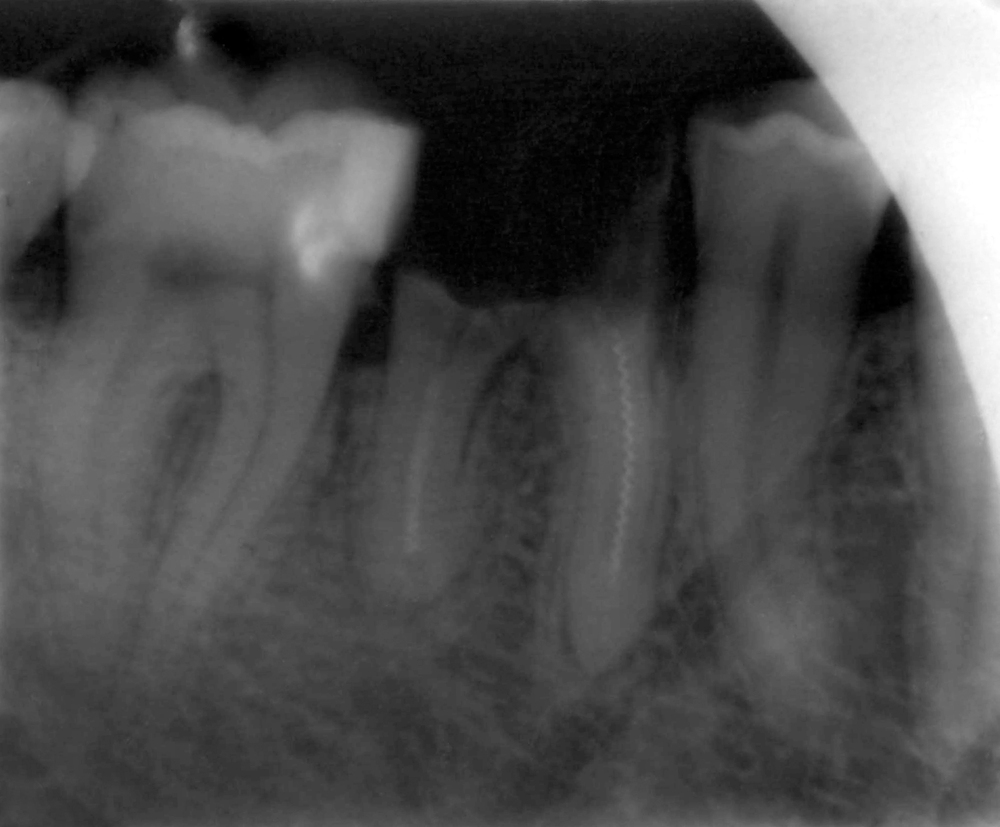 broken molar tooth portland